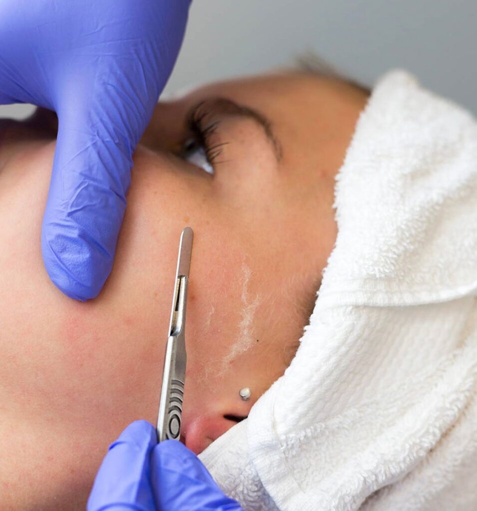 dermaplaning